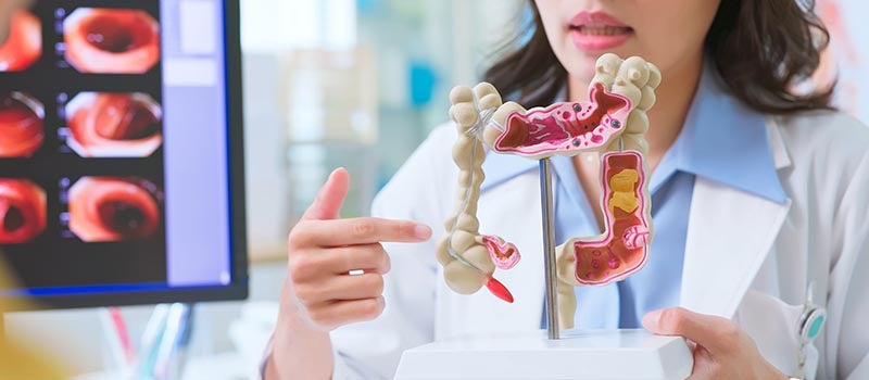 Colorectal cancer model
