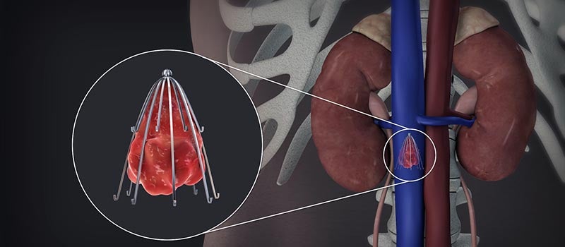IVC filter