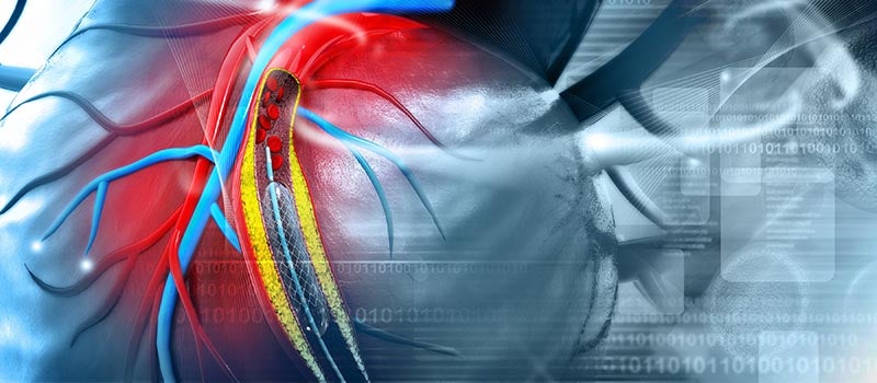 cardiac stent