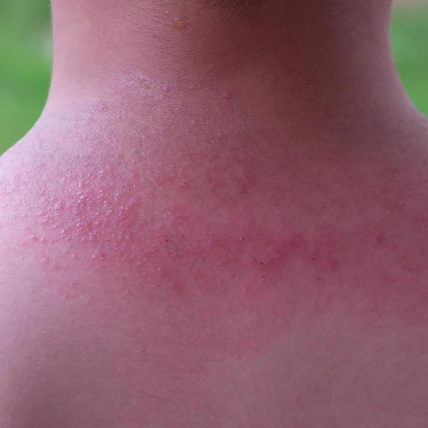 heat rash