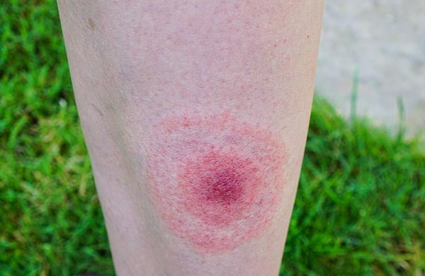 lyme disease rash