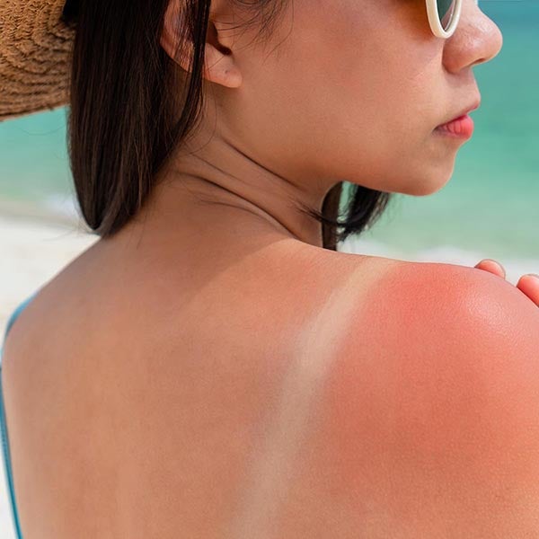 girl with sunburn