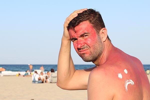 man with sunburn