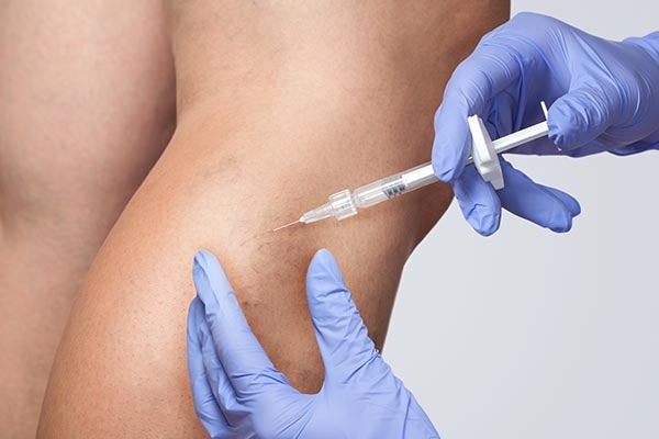 CVI sclerotherapy