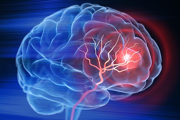 stroke attack