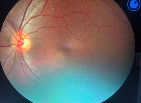 retinopathy scan
