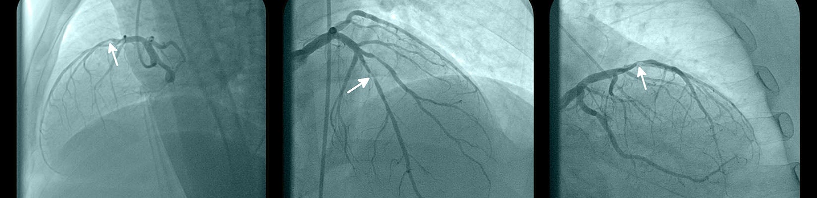 cardiac stent