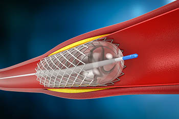 Angioplasty Stent